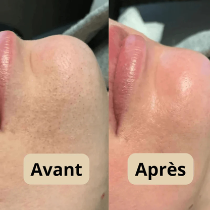 Peel shot Coréen  - Élimine les Impuretés et Sublime Votre Peau !
