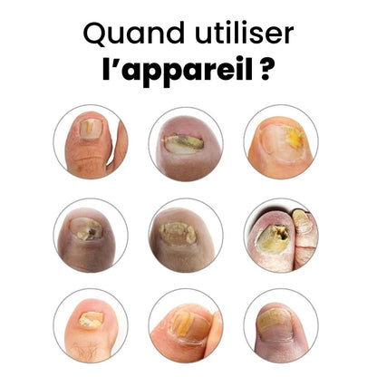 OrthoVital : Retrouvez des Ongles Parfaits en 3 Semaines