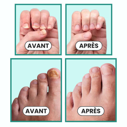 OrthoVital : Retrouvez des Ongles Parfaits en 3 Semaines
