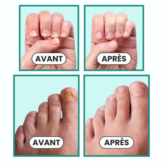 OrthoVital : Retrouvez des Ongles Parfaits en 3 Semaines